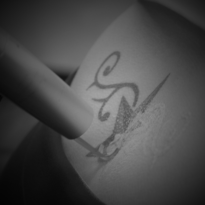Eliminación de tatuajes