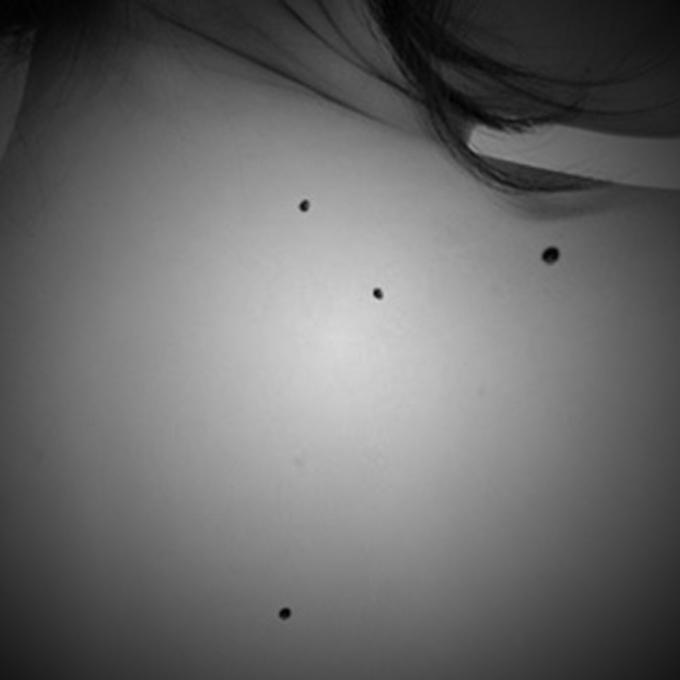 Nevus Rubí