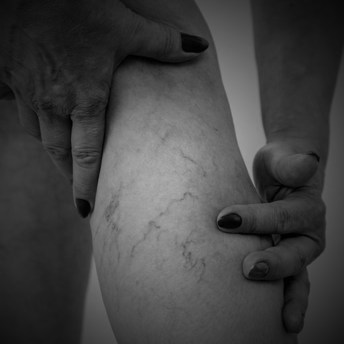 Varices